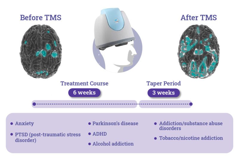 What Is TMS Therapy? | Madison Avenue TMS & Psychiatry