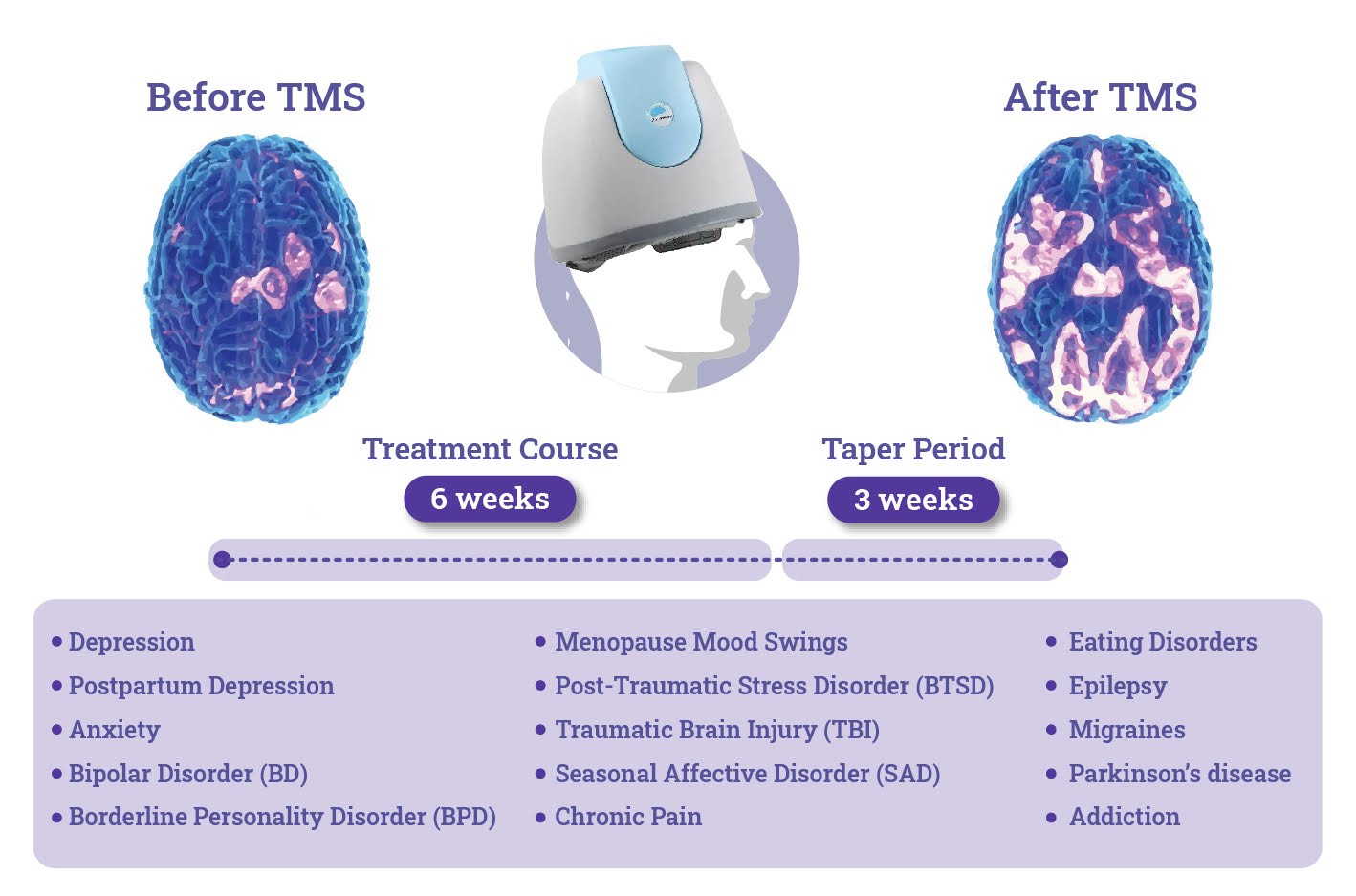 Tms therapy process